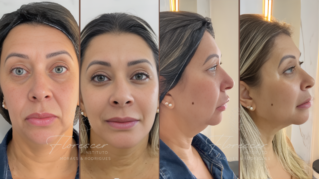 Harmonização Preenchimento facial