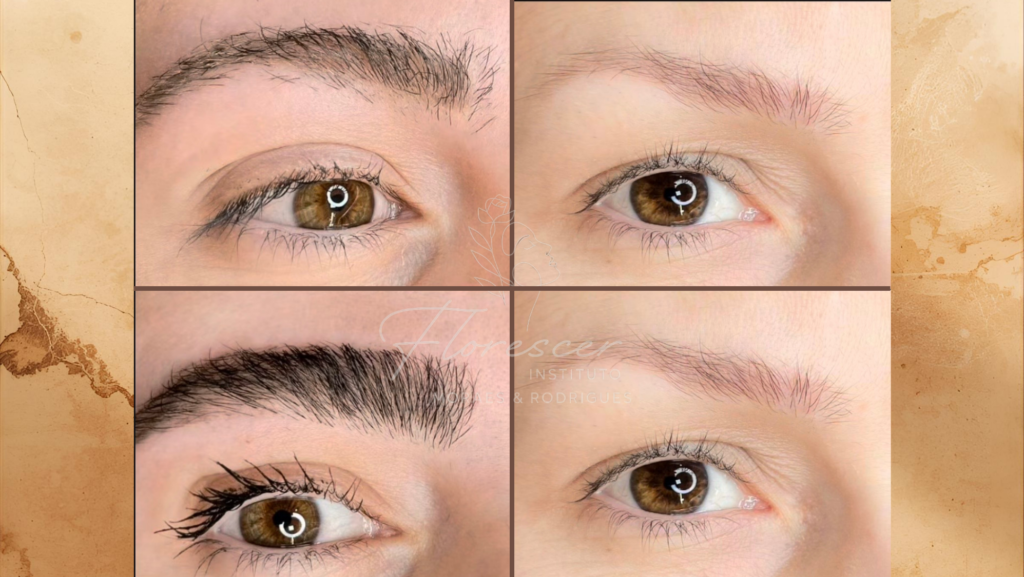 Reconstrução de Sobrancelha