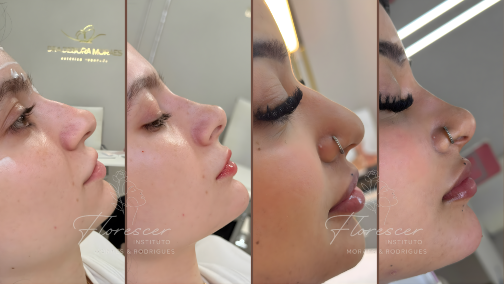 Rinomodelação Profissional resultados reais